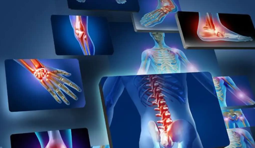 Arthritis