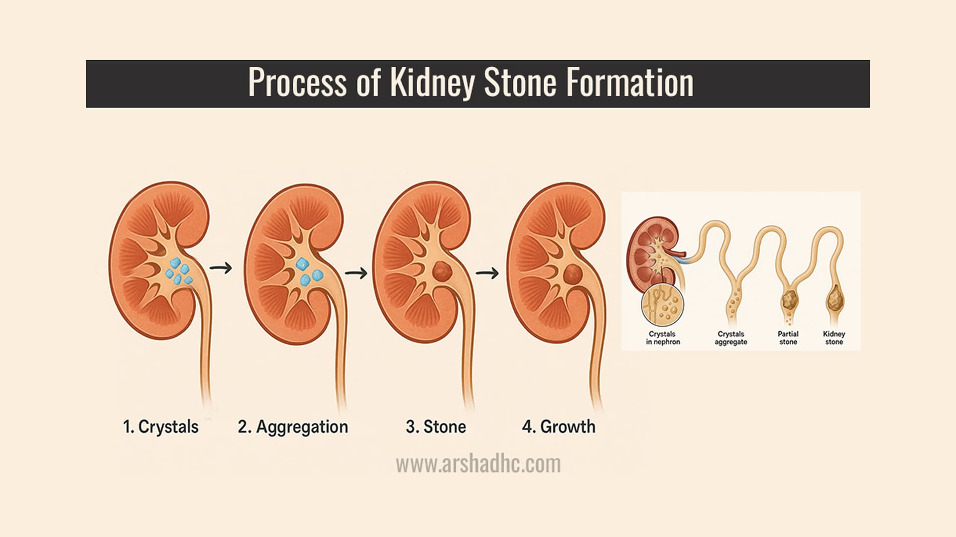 Illustration showing the Kidney Stone Formation