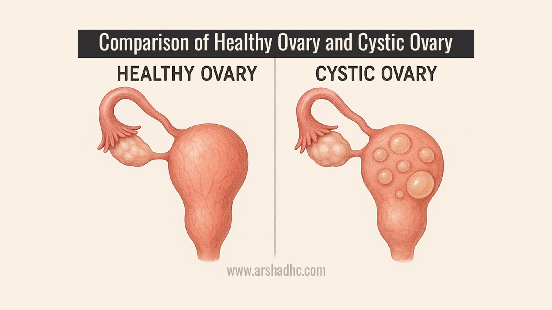 Illustration showing the comparison between a healthy ovary and cystic-ovary