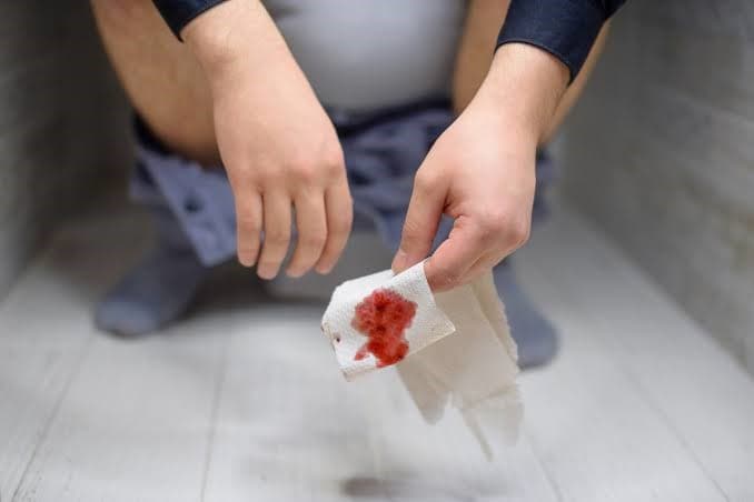 Piles (Hemorrhoids)
