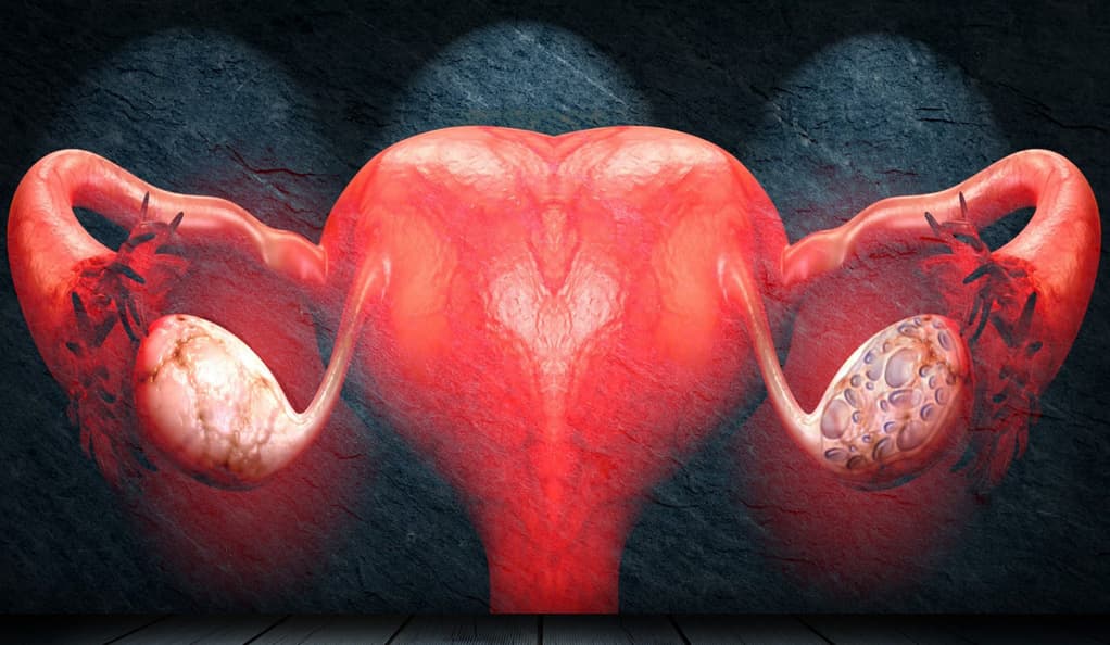 PCOS