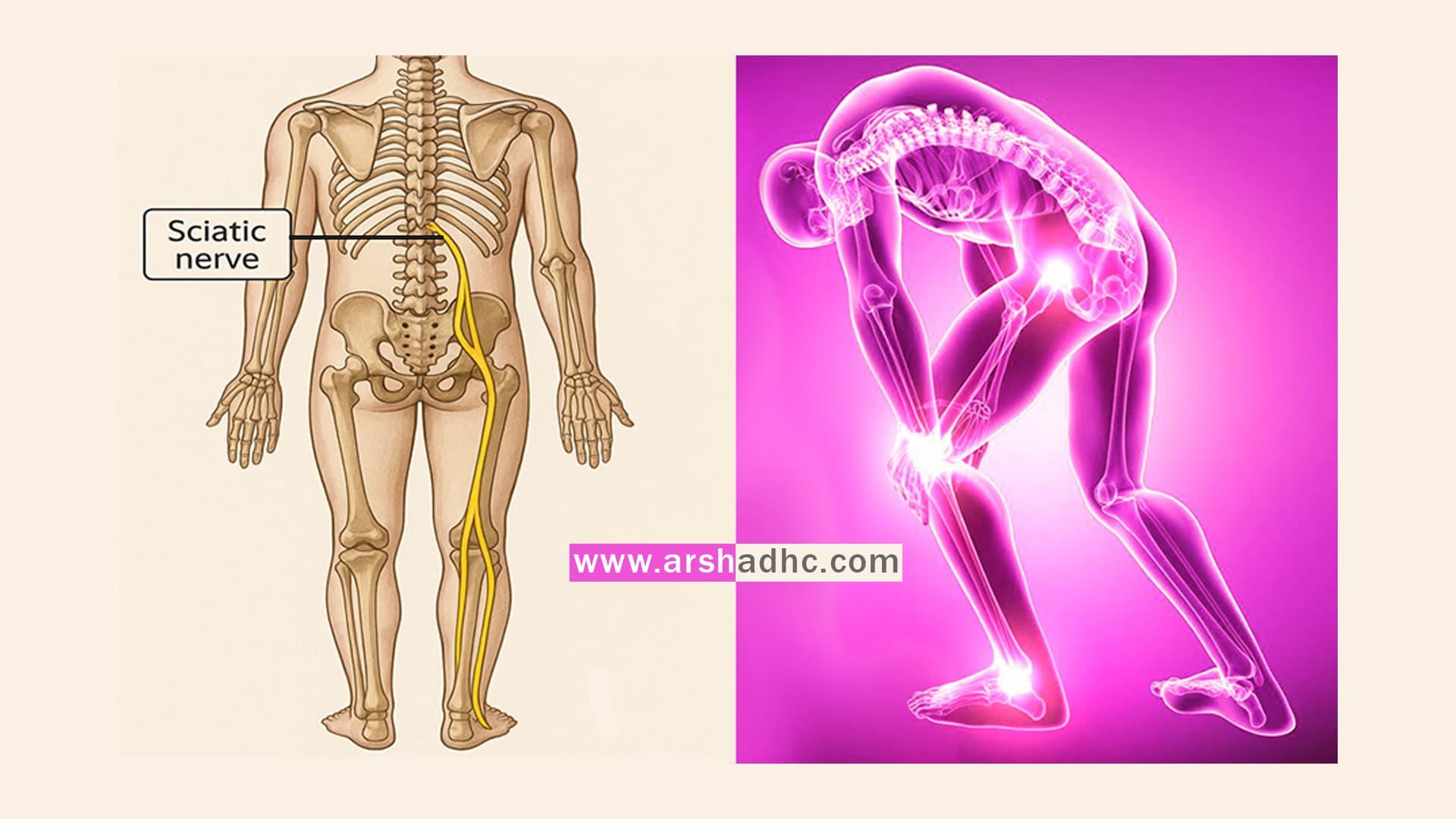 Illustration showing the Sciatic Nerve Path