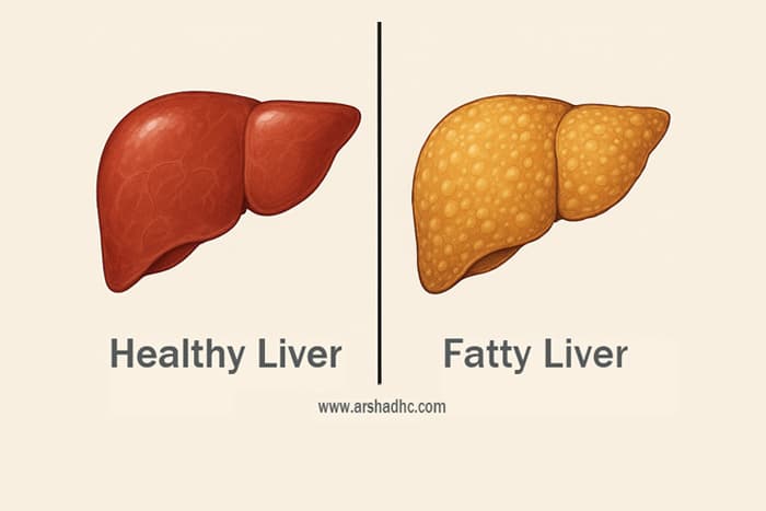 Illustration showing the comparison between fatty liver and healthy liver
