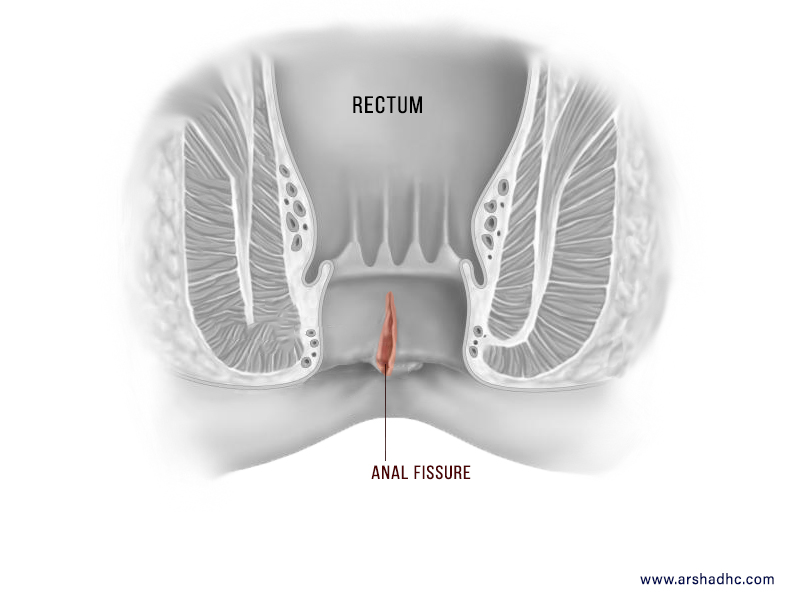 anal fistula picture