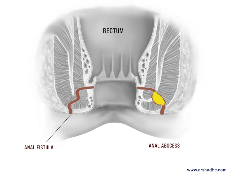 anal fistula images