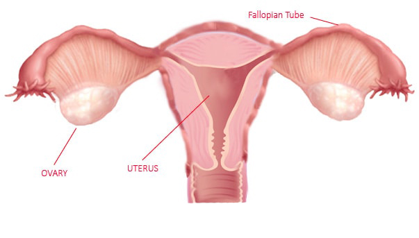 Ovarian Cyst