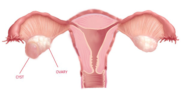 Ovarian Cyst Causes