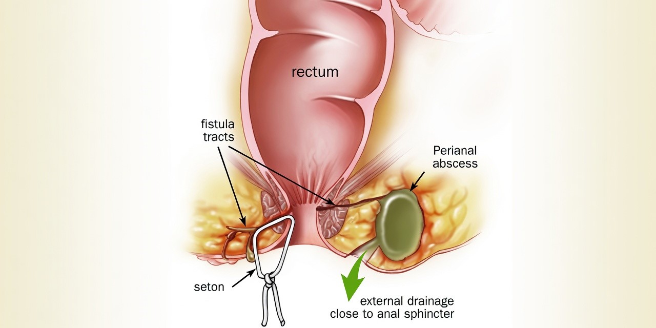 Illustration of anal fistula treatment planning