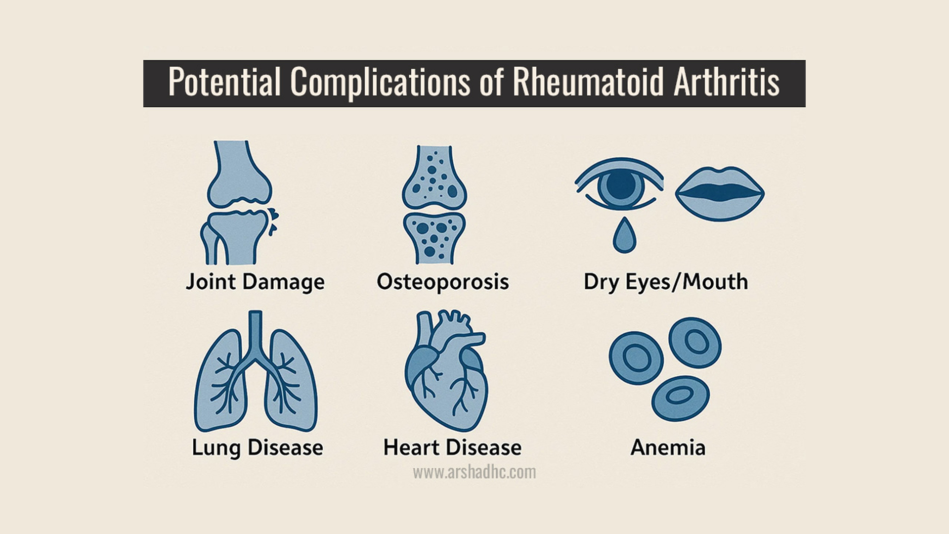 Illustration showing the complications occurs of uncured Arthritis