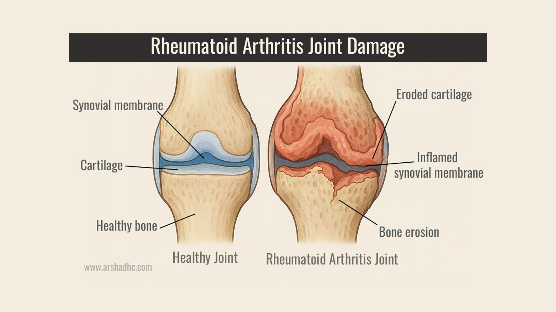 Illustration showing the Healthy joint and Arthritis joint
