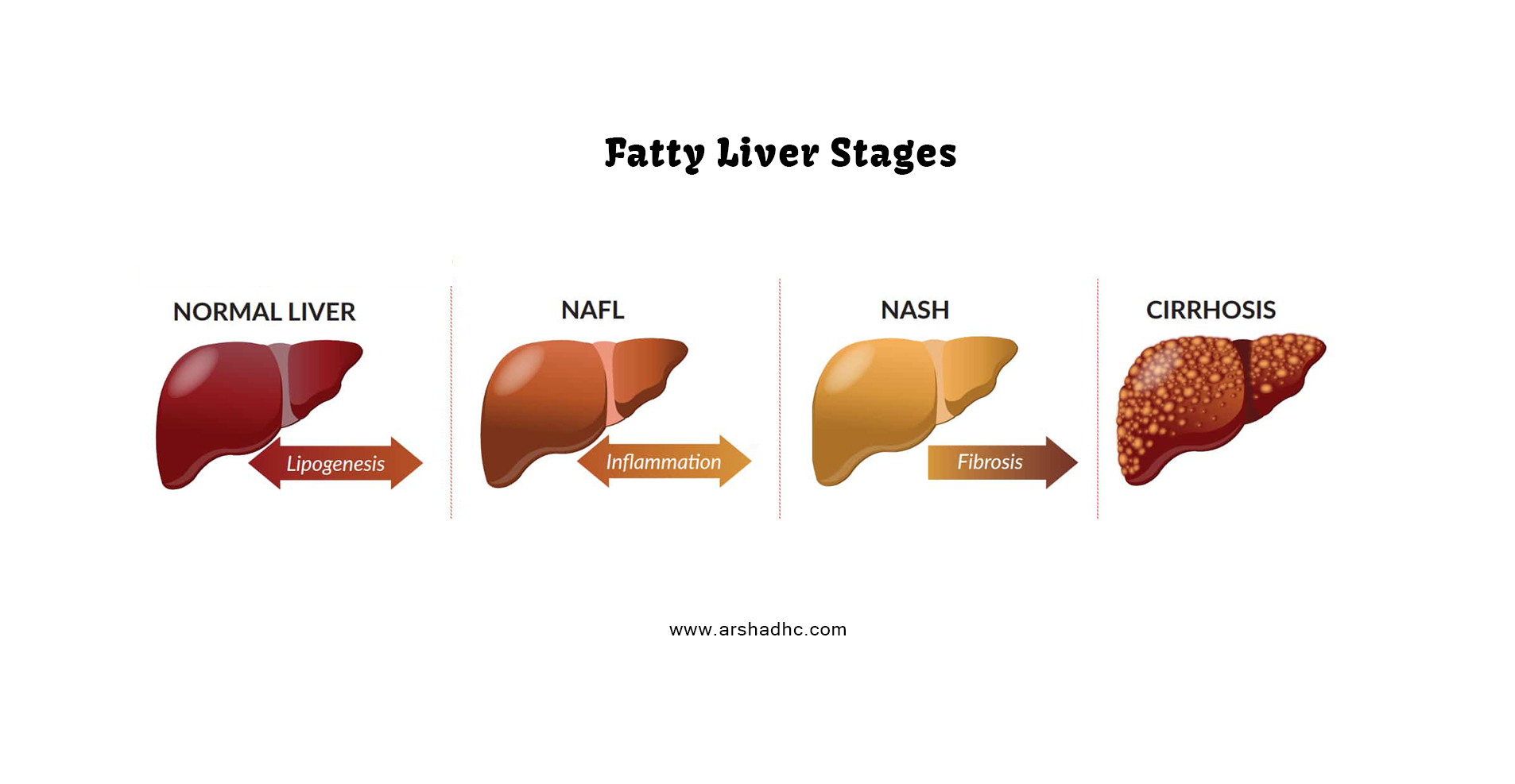 Illustration showing the stages of fatty liver