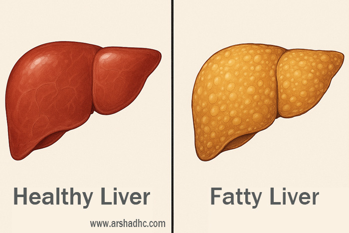 Illustration showing the comparison between fatty liver and healthy liver