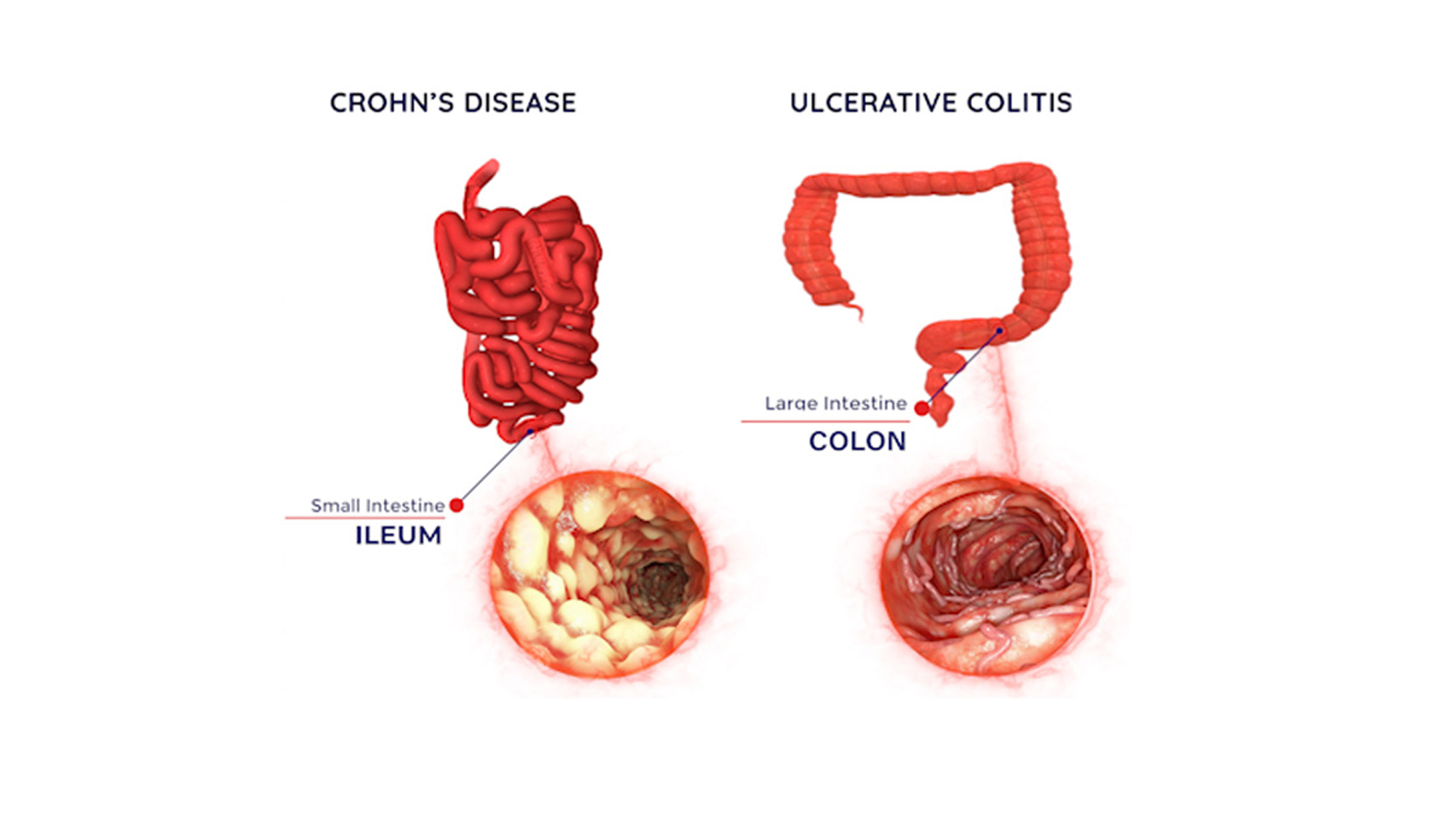 Illustration showing the Inflammed and Healthy Gut