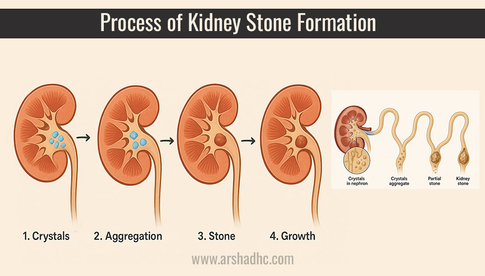 Process of kidney stone formation