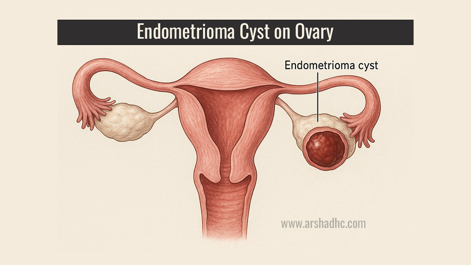 Illustration showing the ovary-cyst having endometriosis