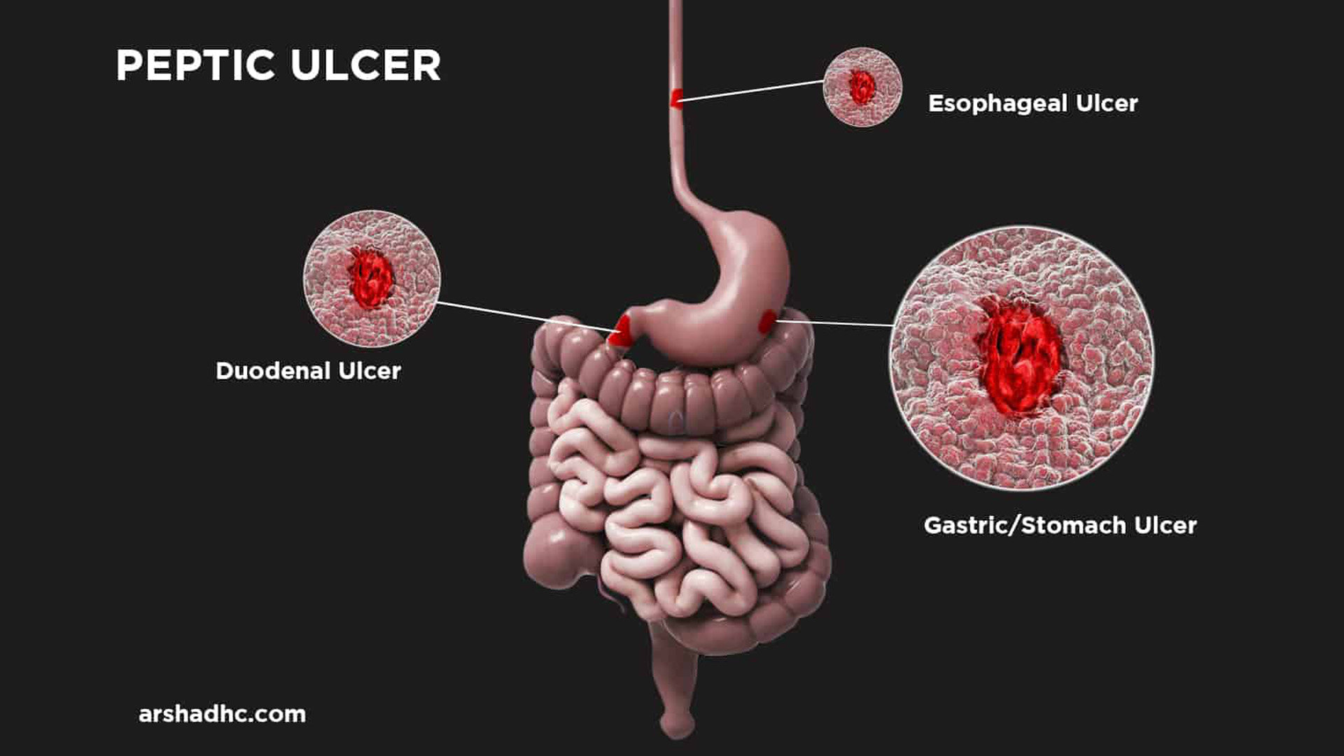 Types of peptic ulcers - gastric, duodenal and esophageal