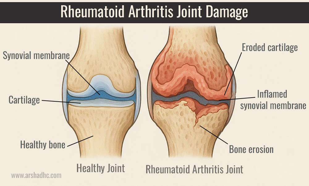Diagram showing rheumatoid arthritis joint damage
