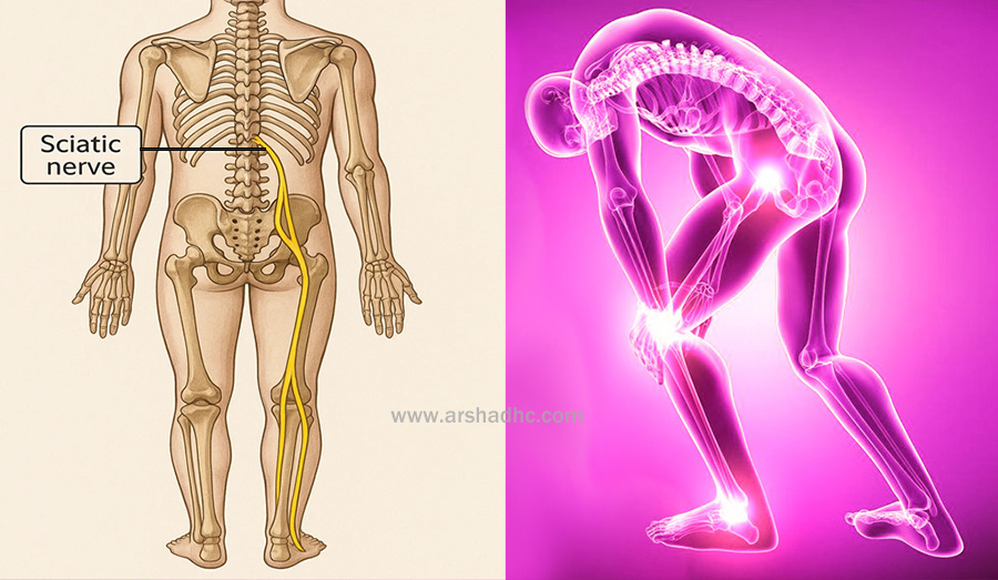 Diagram showing sciatic nerve path from lower back to legs