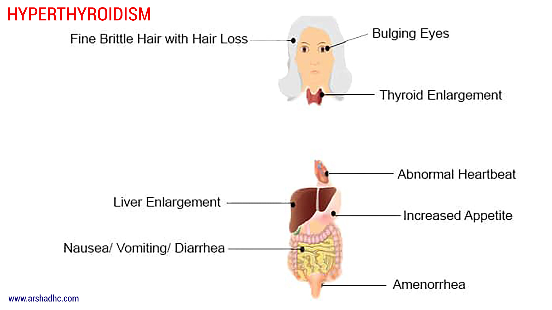 hyperthyroidism