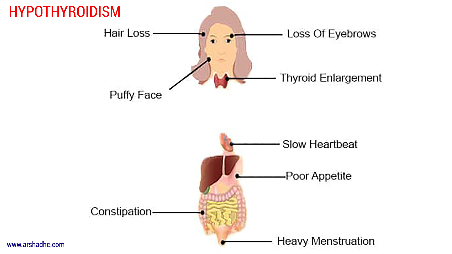 hypothyroidism